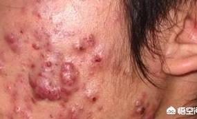 痘痘和痤疮的区别图片,脸上痘痘特别密集是痤疮吗？
