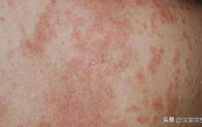 皮炎和湿疹的区别图片,癣和皮炎到底有什么区别？