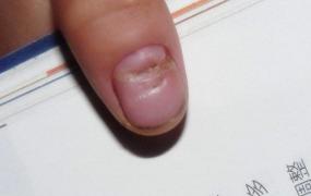 指甲上有横纹凹陷图片,指甲上出现凹横杠是什么病？
