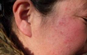 脸部皮炎症状,化妆品皮炎的症状特征有哪些？