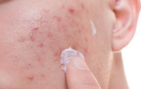 脸上痘痘可不可以挤 长痘痘与皮肤代谢不畅有关