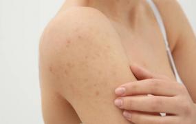 敏感性皮肤问答篇 皮肤过敏的十种防治措施