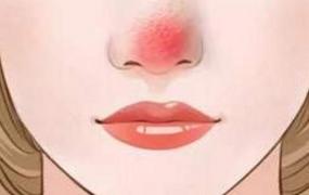 鼻子老是红红的怎么办 科学改善酒糟鼻的方法