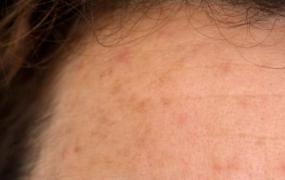 脸上长斑调理的方法大全 预防脸上长出斑点需防晒