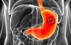 胃癌的发病原因有哪些