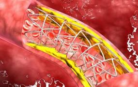 人到40岁血管易堵 颈动脉堵塞的原因揭秘