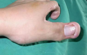 世界上最大的手指:食指长达30厘米(相当于成年人小臂)