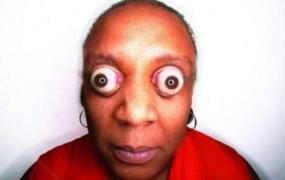 世界上眼球最突出的女人，金·古德曼（眼睛凸出11毫米）