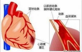 心肌梗塞的前兆和表现,心肌梗塞病人的症状有哪些？
