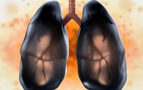 外推容积临床意义,肺气肿有多严重？会危及生命吗？