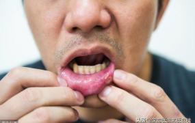 口腔癌的早期症状,口腔癌常见的症状有哪些？