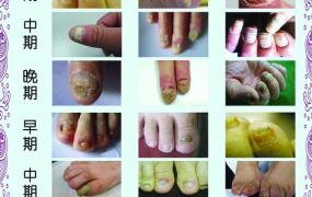 手指甲灰指甲前兆,灰指甲不及时治疗引起哪些疾病？
