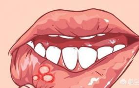 为什么会有口腔溃疡,口腔溃疡到底是什么原因造成的？