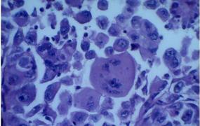 肿瘤和癌症的区别,活检发现肿瘤细胞是癌细胞吗？