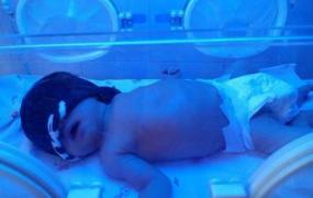新生儿照蓝光有什么副作用,蓝光对新生儿有害吗？如何预防？