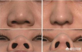 缩小鼻翼的方法,鼻头鼻翼缩小的方法有哪些？