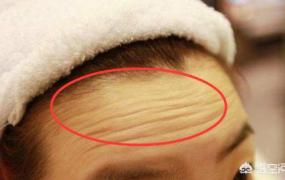 小切口除皱术,脸上皱纹多而且皮肤松弛怎么办？