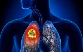 外周血是什么意思,外周血验肺癌到底靠谱吗？