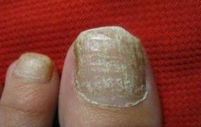 灰指甲的症状图片,身体缺什么营养会得“灰指甲”？