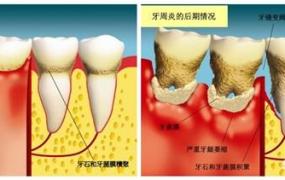 牙龈萎缩的治疗方法,牙龈萎缩导致牙根外露怎么办？