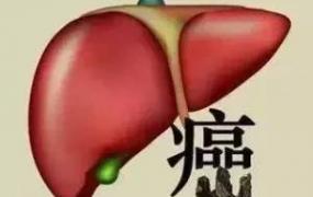 肝癌什么症状,肝癌的五大早期症状是什么？