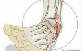 扭伤脚踝,关于脚踝扭伤的治疗方法？