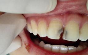牙疼怎么止疼,有什么速效方法缓解牙痛吗？