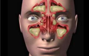 鼻炎的症状表现,什么是鼻窦炎，有哪些表现？