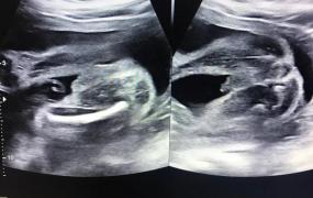 怀男孩的症状,怀孕32周男宝的样子是怎样的？