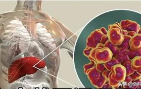 肝肿瘤的早期症状,肝脏癌变在人体上有哪些表现？