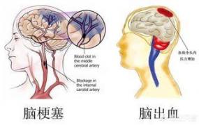 脑梗和脑出血哪个严重,脑梗和脑出血一定昰血压高吗？