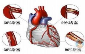 心梗,心绞痛一定是心梗的前兆吗？