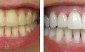 如何使黄牙变白牙,如何让黄牙变白并长期保持？