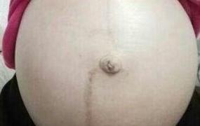 妊娠线看男女,怀孕时肚子上的黑线有什么作用？