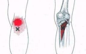 膝盖后面的筋疼怎么治,膝关节后面筋痛怎么回事？