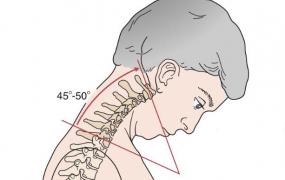 颈椎前倾,为什么长期低头容易得颈椎病？