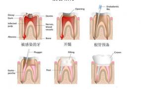 戴牙套有什么副作用,牙齿的根管治疗有什么危害？