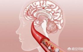 脑梗和脑溢血哪个严重,脑血栓和脑梗塞有关系吗？