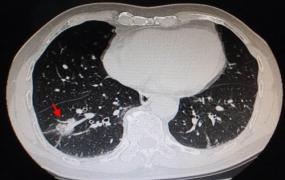 肺癌前期有什么症状,肺癌的症状和前兆是什么？