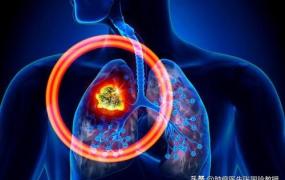 早期肺癌的6大症状,肺癌早期，身体会有哪些症状？