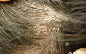 头皮屑多是什么原因女,头发上很多头皮屑，该怎样清理？
