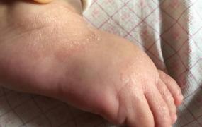 儿童湿疹症状图片,小宝宝长干性湿疹怎么办？