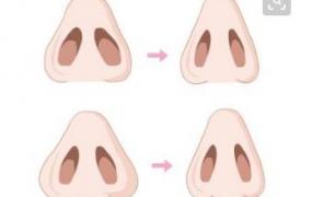 鼻孔变小,鼻孔大建议做鼻孔缩小手术吗？