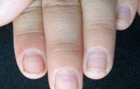 指甲上有横纹,指甲上有横纹是怎么回事？