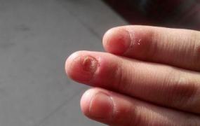 轻微灰指甲图片,关于孩子指甲的问题，困扰已久？