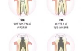 牙的结构,牙齿蛀牙的过程是怎样的？