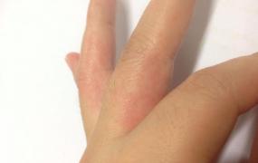 手指上长小水泡,手指上长小水泡是什么原因？