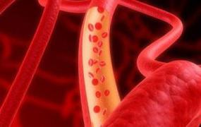 血栓是什么,有哪些血栓正在堵塞血管的征兆？