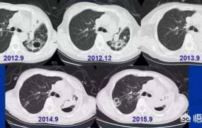 肺结核多久才是晚期,得了肺结核晚期，是不是没得医？