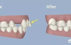 黑三角牙齿,牙齿矫正中如何避免出现黑三角？